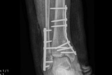 انجام عمل خوردشدگی سطح مفصل مچ پا در بیمارستان قدس پاوه