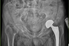 انجام عمل تعویض مفصل لگن بیمار ۷۲ ساله در بیمارستان قدس پاوه