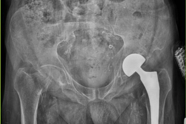 انجام عمل تعویض مفصل لگن بیمار ۷۲ ساله در بیمارستان قدس پاوه