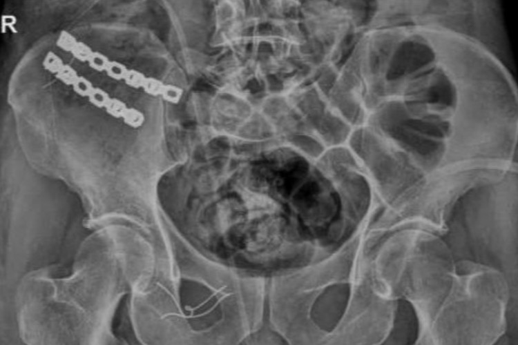 انجام عمل موفقیت آمیز شکستگی شانه و خوردشدگی لگن در بیمارستان پاوه