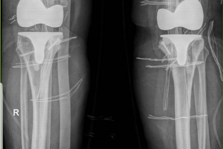 تعویض مفصل دو طرفه زانو‌همزمان در یک عمل در بیمارستان پاوه