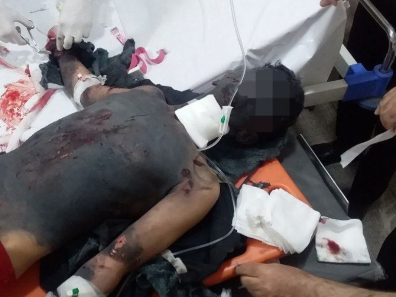 حادثه قطع عضو در اثر انفجار ترقه در روانسر حادثه قطع عضو در اثر انفجار ترقه در روانسر