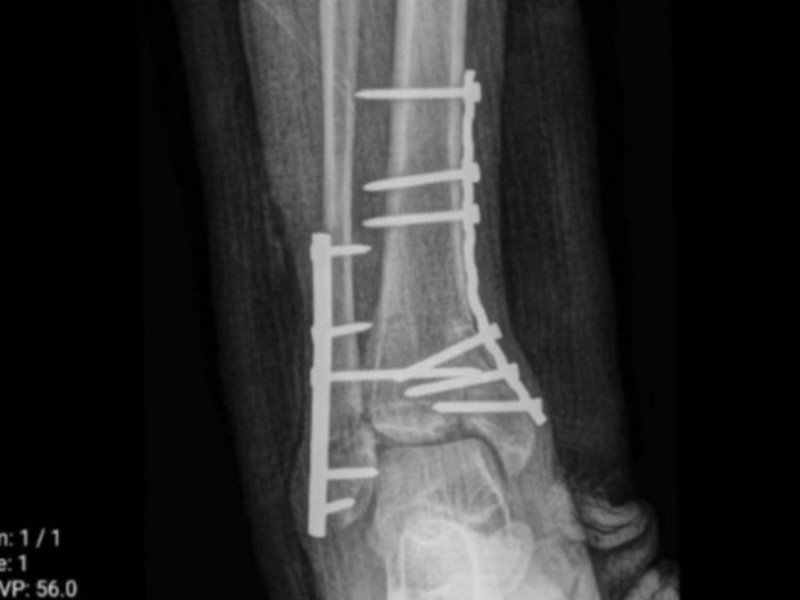 انجام عمل خوردشدگی سطح مفصل مچ پا در بیمارستان قدس پاوه