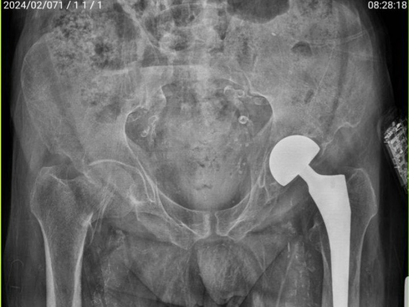 انجام عمل تعویض مفصل لگن بیمار ۷۲ ساله در بیمارستان قدس پاوه